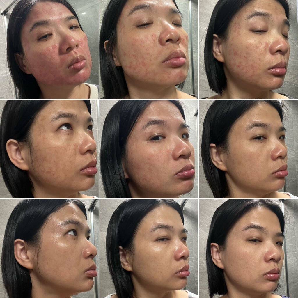 醫美雷射後使用DOCTOB植萃保養品牌九天比較-右臉頰