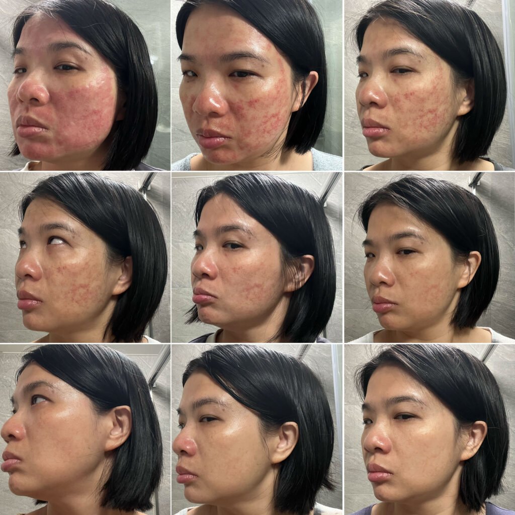 醫美雷射後使用DOCTOB植萃保養品牌九天比較-左臉頰